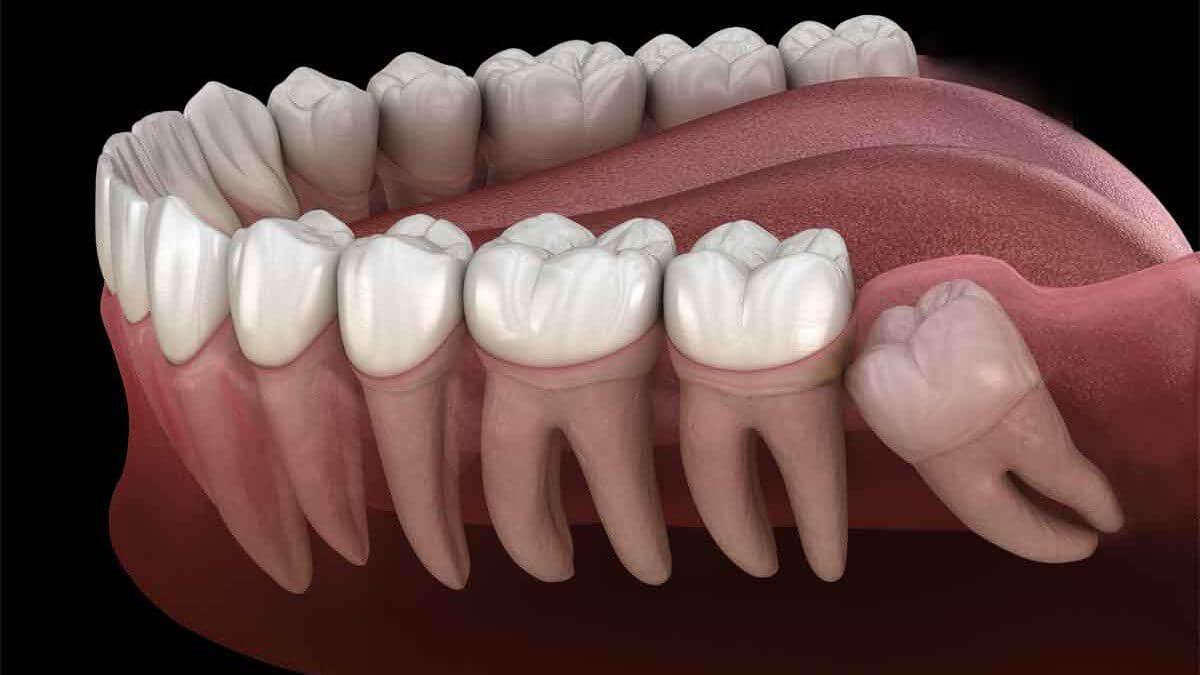 Виды и причины аномалий форм зубов